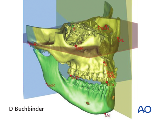 Planning of orthognathic surgery