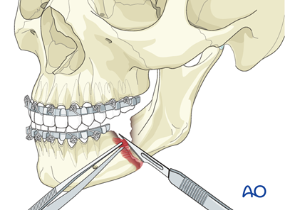 Debridement and internal fixation for Mandibular nonunion - Malocclusion