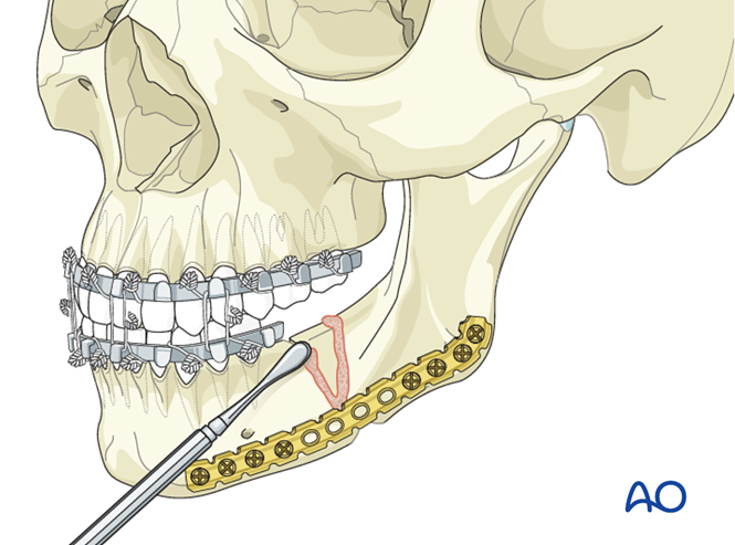 Debridement and internal fixation for Mandibular nonunion - Malocclusion