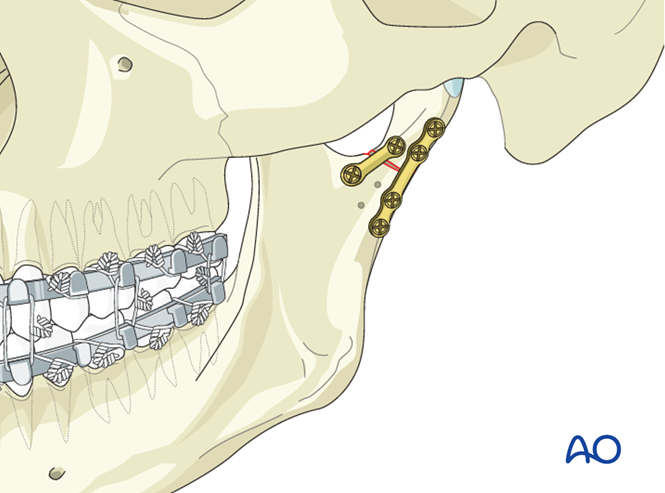 Osteotomy and internal fixation for Mandibular malunion - TMJ Dysfunction