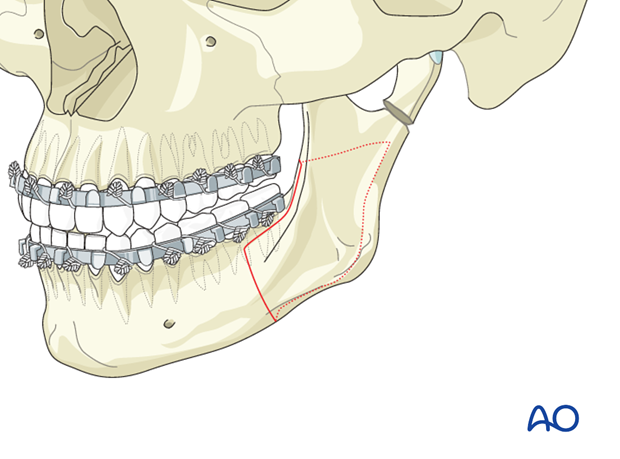 Orthognathic procedures for Mandibular nonunion - Malocclusion