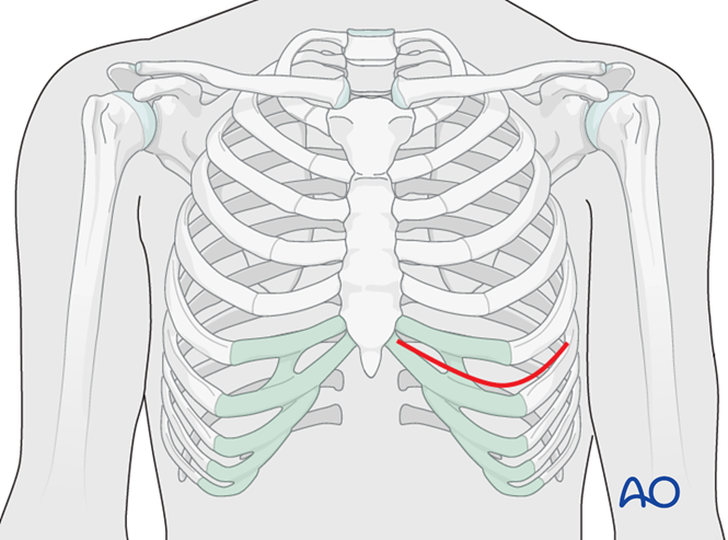 Condylar replacement - Autogenous for Mandibular nonunion - TMJ Dysfunction