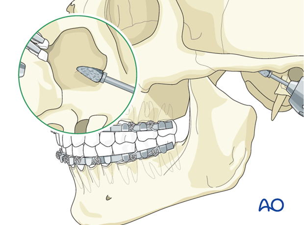 Total joint replacement - Alloplastic for Mandibular nonunion - TMJ ...