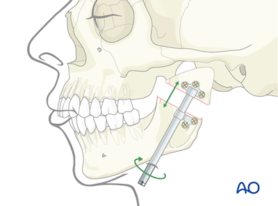 Arthroplasty and distraction osteogenesis for Mandibular hypomobility ...