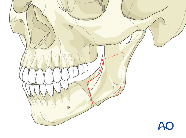 Orthognathic surgery for Mandible - Facial asymmetry