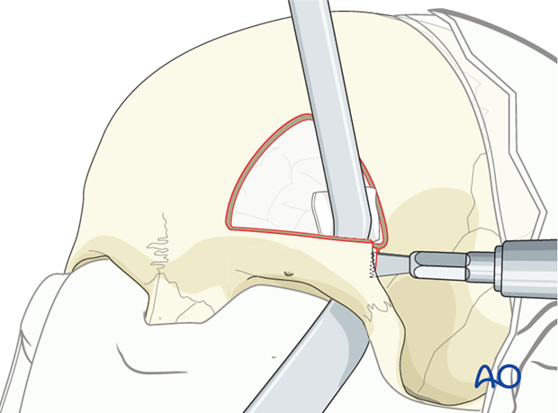 Orbitotomy Instruments Orbitotomy with orbital roof repositioning for Supraorbital ridge ...