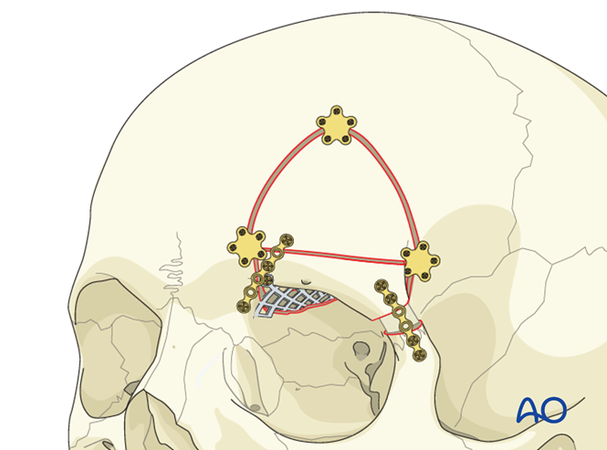 Orbitotomy with orbital roof repositioning for Supraorbital ridge ...