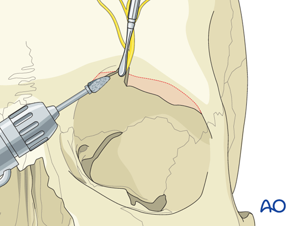 Contouring for Supraorbital ridge/orbital roof malposition