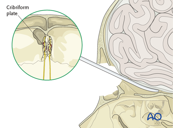 Subcranial approach