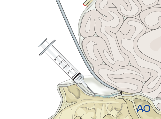 Transcranial CSF leak repair for CSF leak/encephalocele