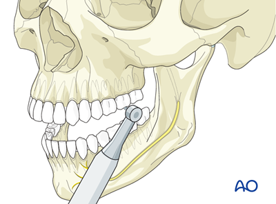 Le Fort I for Maxillary malposition/widening