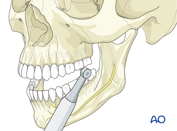 Le Fort I for Maxillary malposition/widening