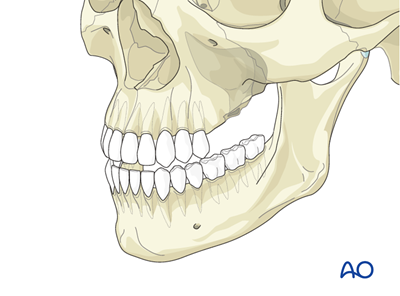 Oro-nasal/antral fistulae