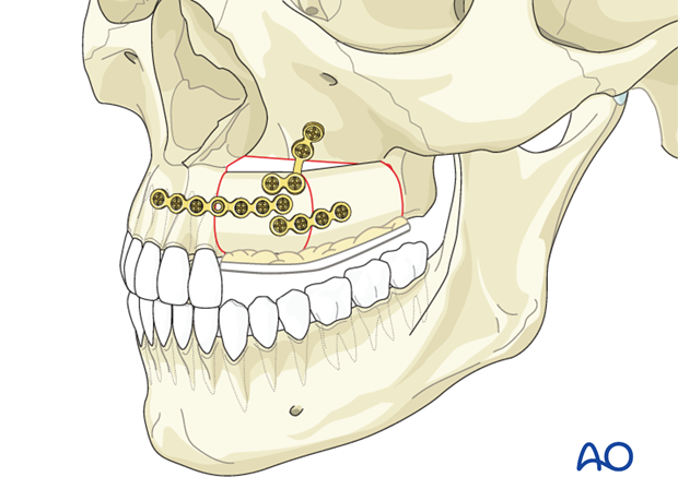 Fibula osteocutaneous flap for Alveolar defects in the maxilla