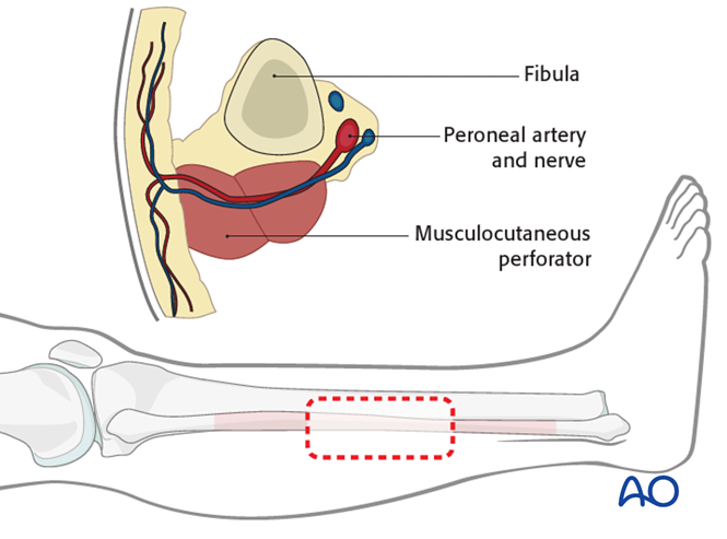 Fibula osteocutaneous flap for Alveolar defects in the maxilla