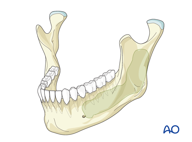 Lateral Mandible, Condyle, Mucosa And Skin