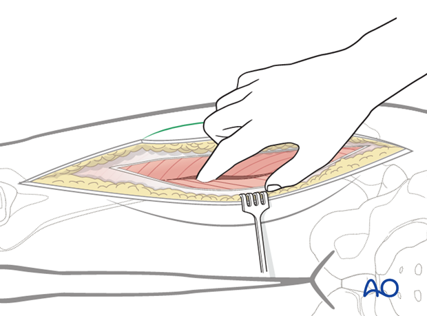 anterolateral thigh