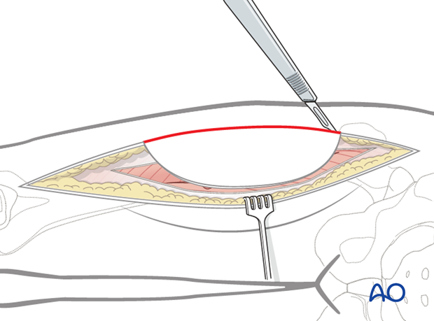 anterolateral thigh