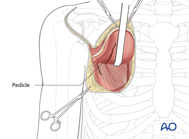 pectoralis myocutaneous pedicle flap