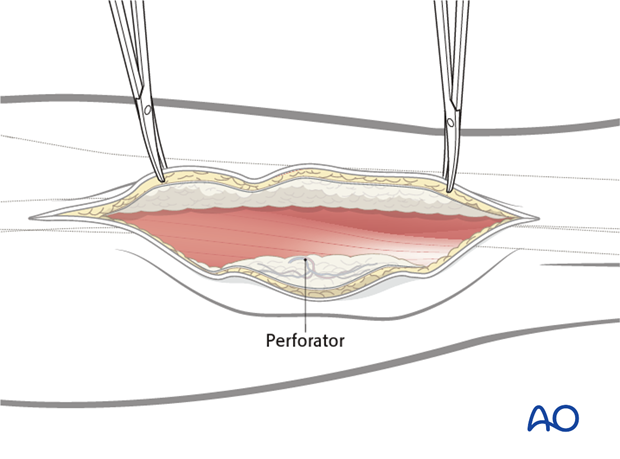 fibula osteocutaneous flap