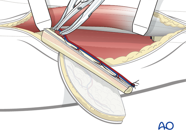 fibula osteocutaneous flap