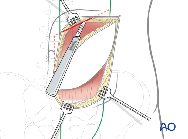 rectus abdominis