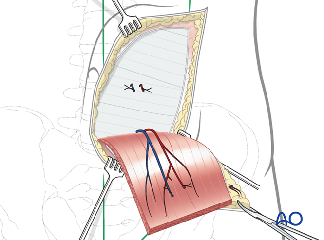Rectus abdominis