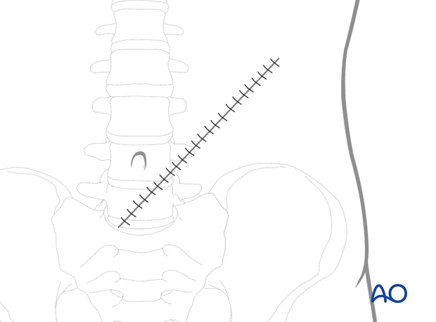 rectus abdominis