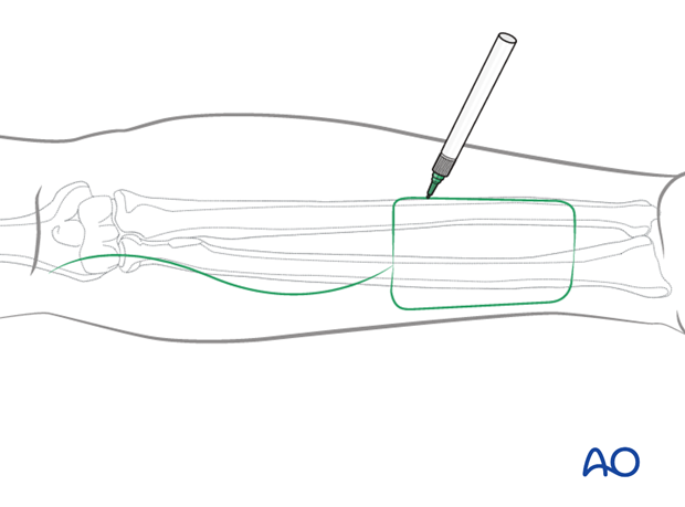 radial forearm