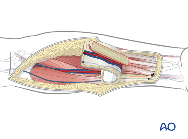 Radial forearm