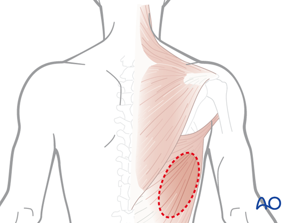 Latissimus dorsi fasciocutaneous free flap for Cranial vault