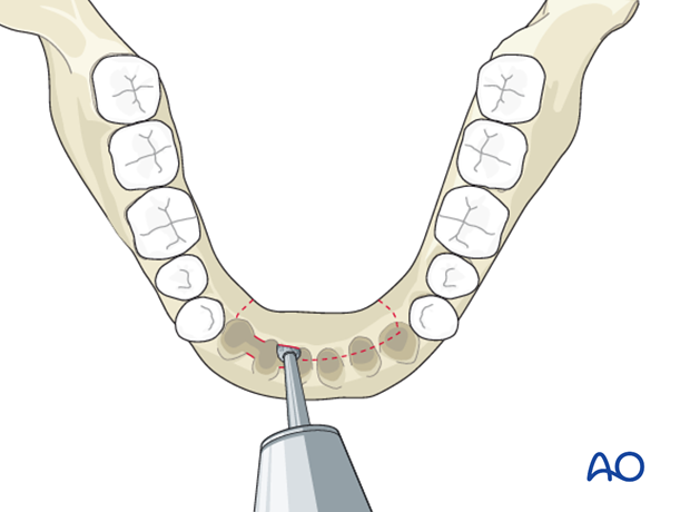 Secondary intention for Marginal mandible, inner cortical