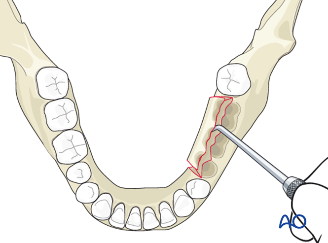 Marginal Tooth Incision Secondary intention for Marginal mandible, inner cortical