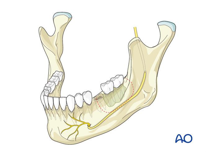 Secondary intention for Marginal mandible, full thickness (double cortical)