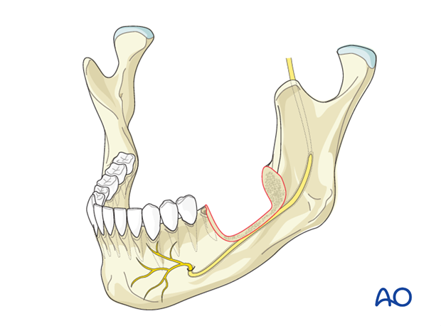 Secondary intention for Marginal mandible, full thickness (double cortical)