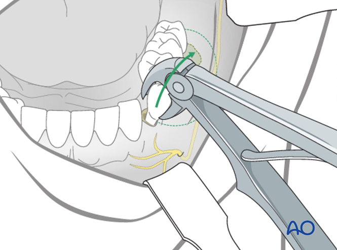 Radial forearm fasciocutaneous free flap for Marginal mandible, full ...