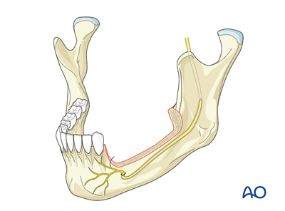 Radial forearm fasciocutaneous free flap for Marginal mandible, full ...