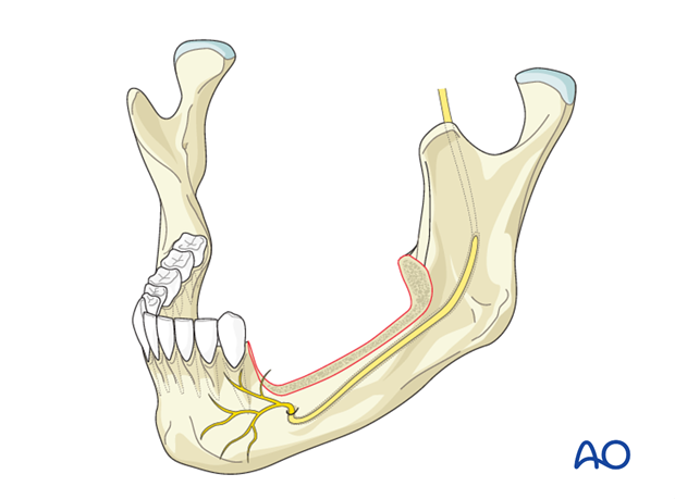 Radial forearm fasciocutaneous free flap for Marginal mandible, full ...