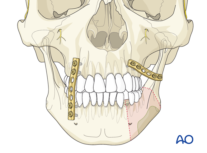 Plate and radial forearm fasciocutaneous free flap for Lateral mandible ...