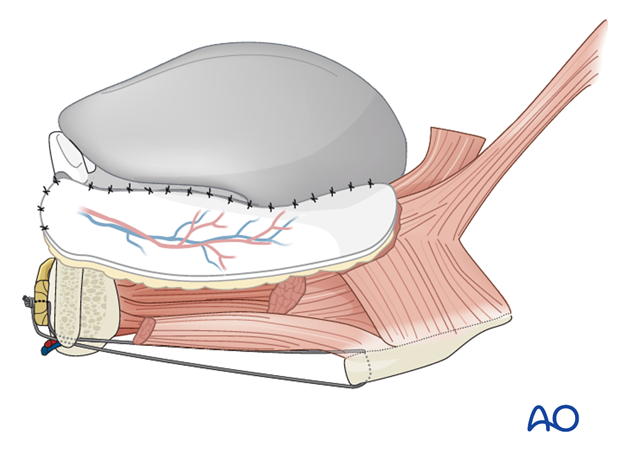 Plate and scapular osteocutaneous free flap for Symphysis, mucosa and skin