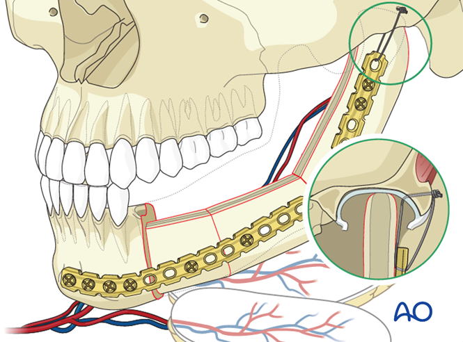 Plate and scapular osteocutaneous free flap for Lateral mandible ...