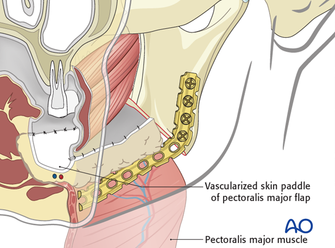 Pedicle Flaps Example Plate and pectoralis major myocutaneous pedicle flap for Lateral ...