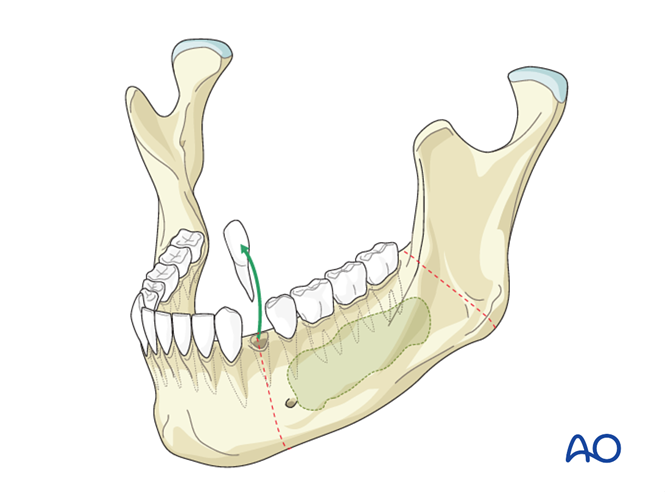 Primary closure for Lateral mandible, mucosa, with or without tongue ...