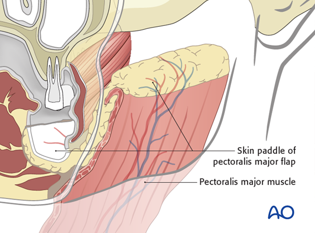 Skin Paddle Incision Pectoralis major myocutaneous pedicle flap for Lateral mandible ...