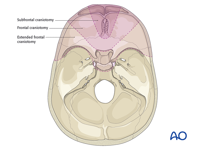 Radial forearm fasciocutaneous free flap for Anterior skull base ...