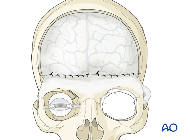 Pericranial And Temporoparietal Fascia Flap For Anterior Skull Base With Orbital Involvement