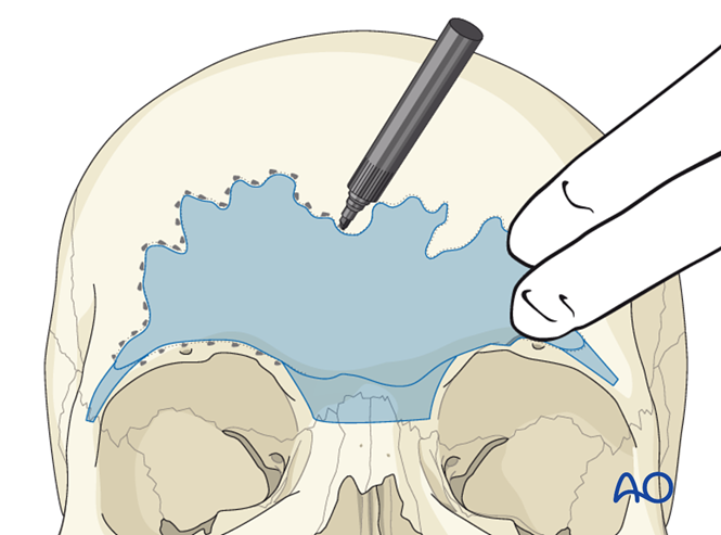 Access osteotomy – Subcranial access osteotomy
