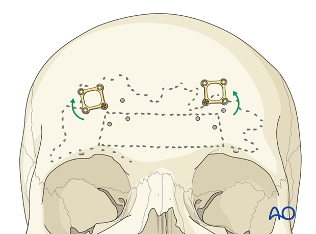 Access osteotomy – Subcranial access osteotomy