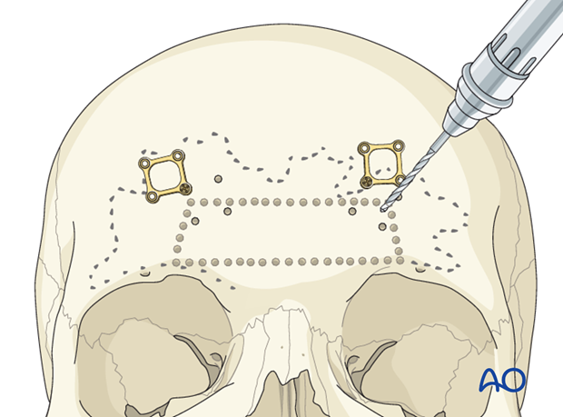 Access osteotomy – Subcranial access osteotomy