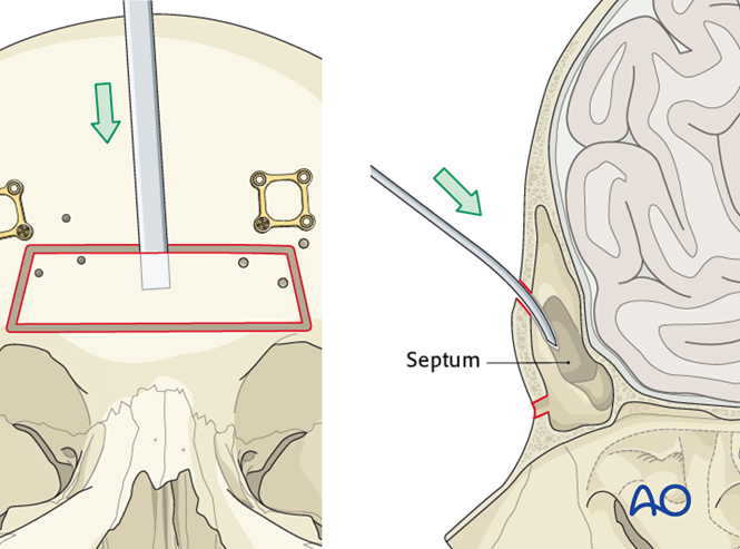 Access osteotomy – Subcranial access osteotomy